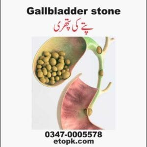 Gallstones