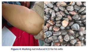 بلادر Marking Nuts Semecarpus anacardium side