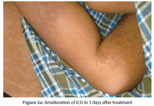 بلادر Marking Nuts Semecarpus anacardium side