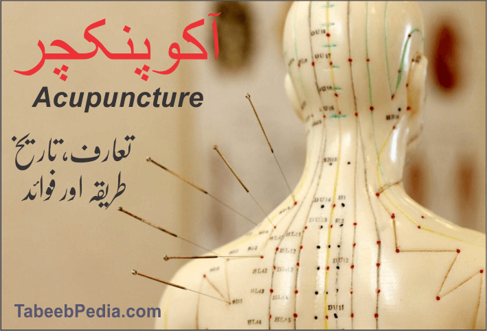 آکوپنکچر Acupuncture