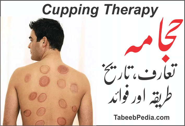حجامہ Cupping Therapy