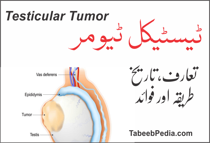 ٹیسٹیکل ٹیومر تشخیص اور علاج