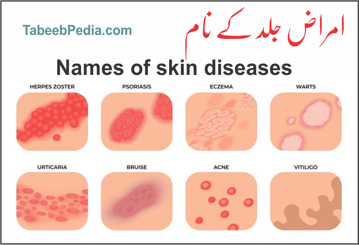 جلدی امراض کے نام اور مطلب